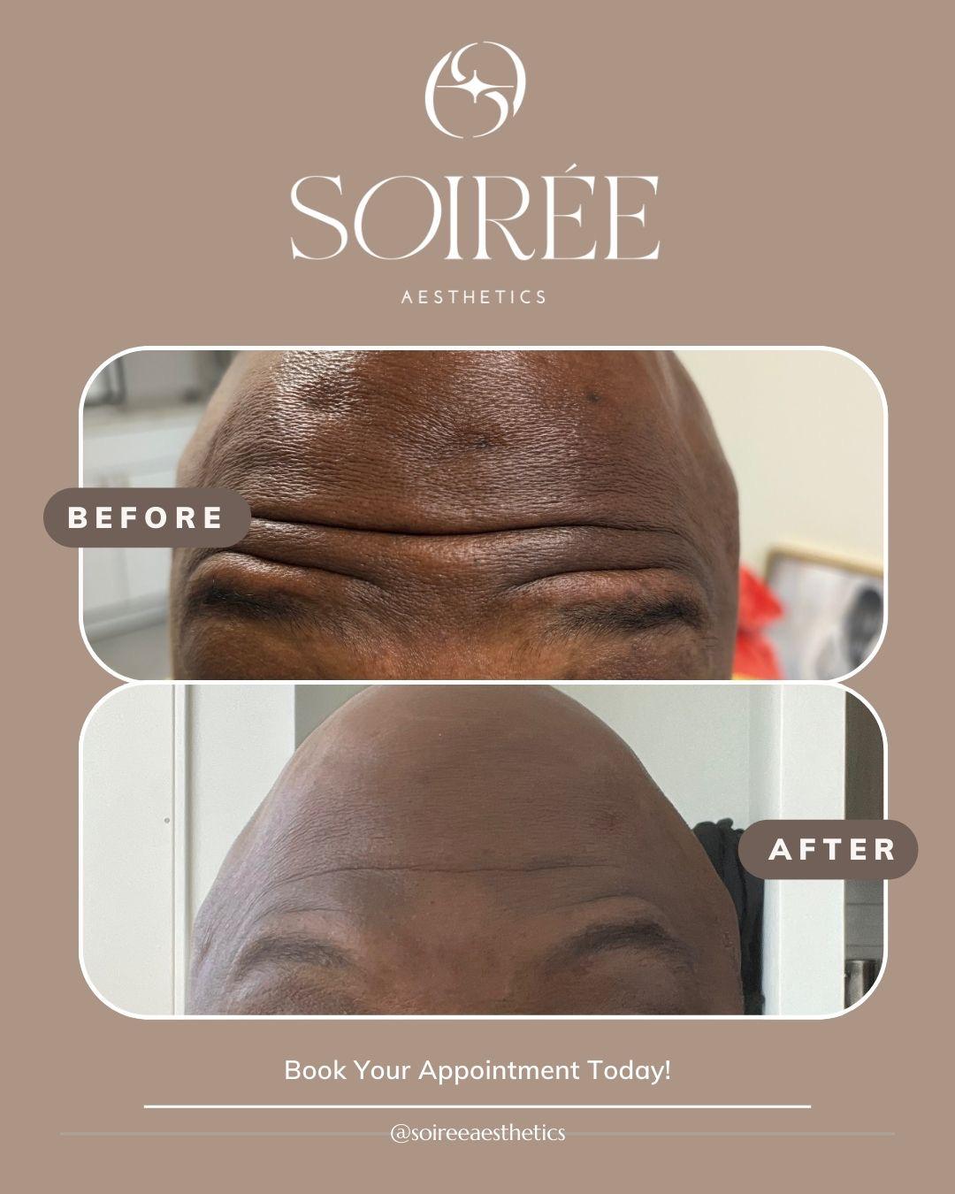 Chemical Peel Before