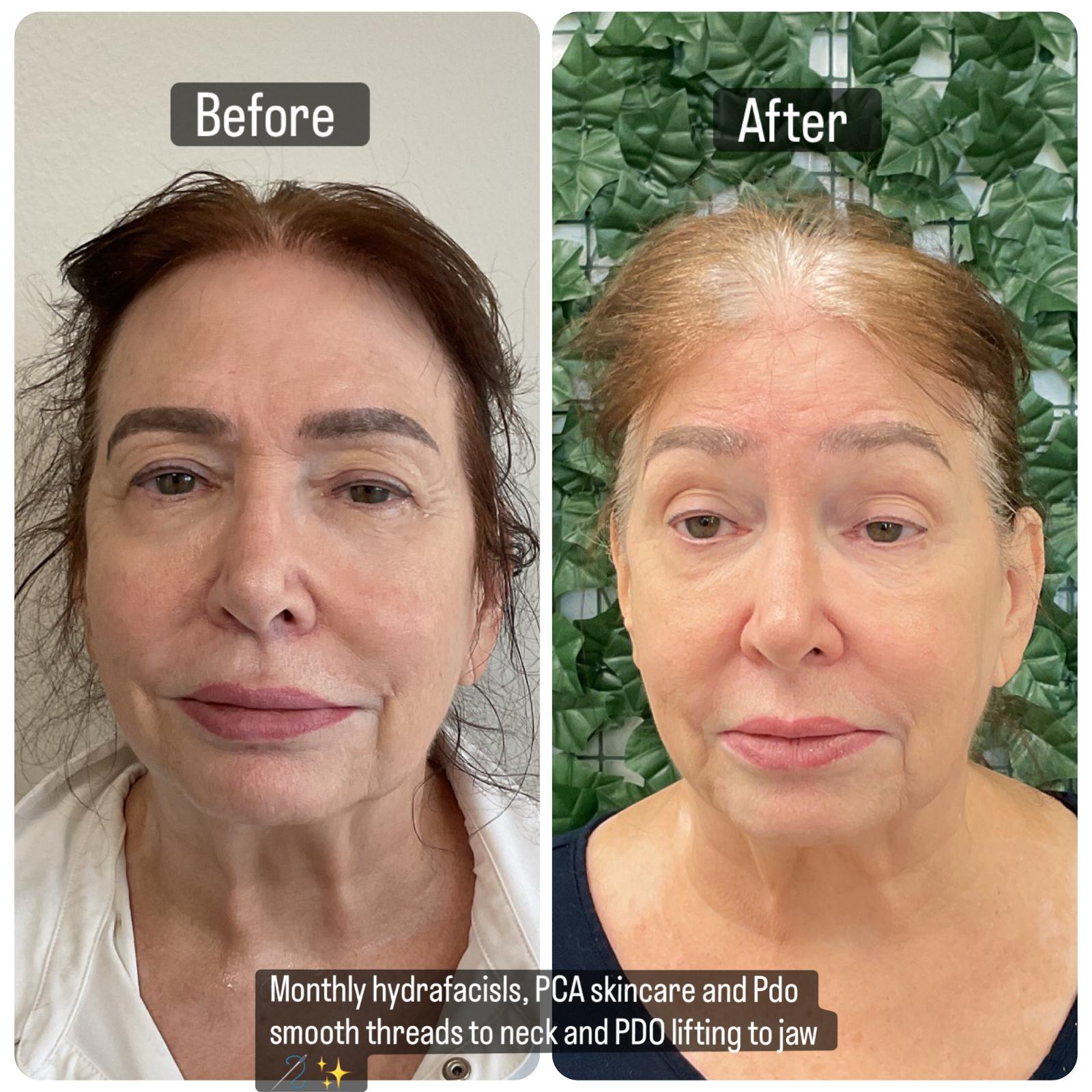 Chemical Peel Before