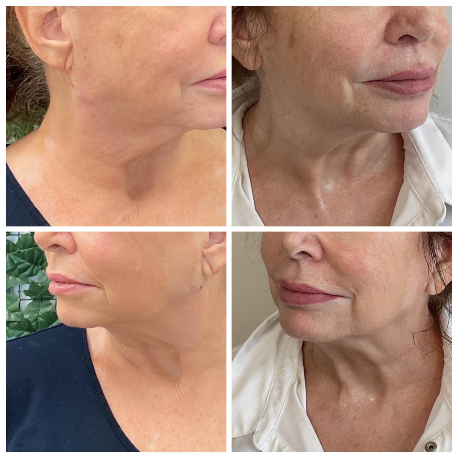 Chemical Peel Before