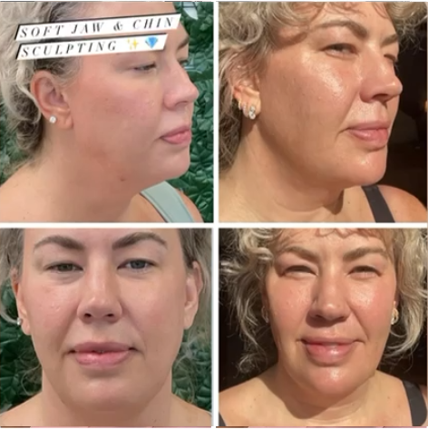 Chemical Peel Before