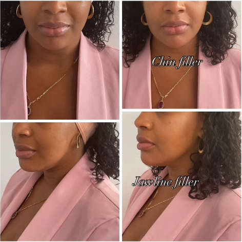 Chemical Peel Before