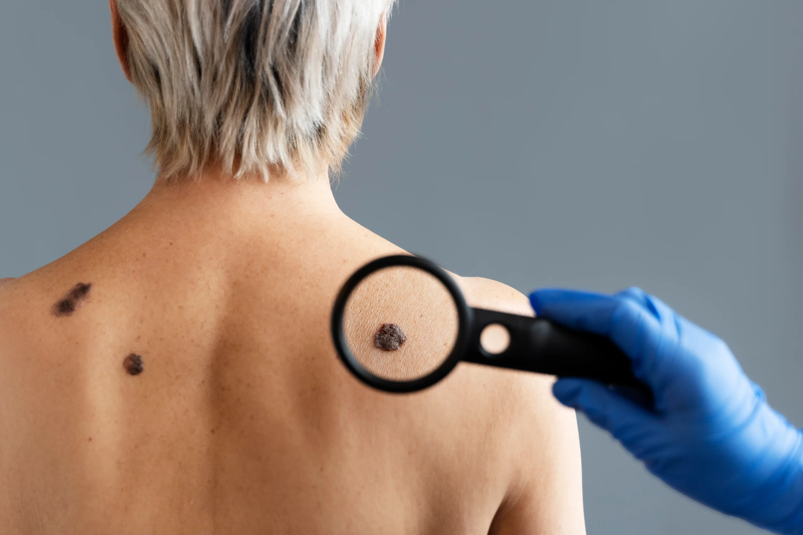 Aesthetic professional performing skin tag removal treatment on a woman’s neck in a clinical setting.