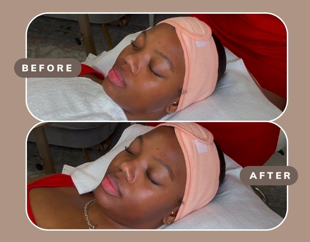 Chemical Peel Before